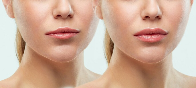 Збільшення губ: фото до і після