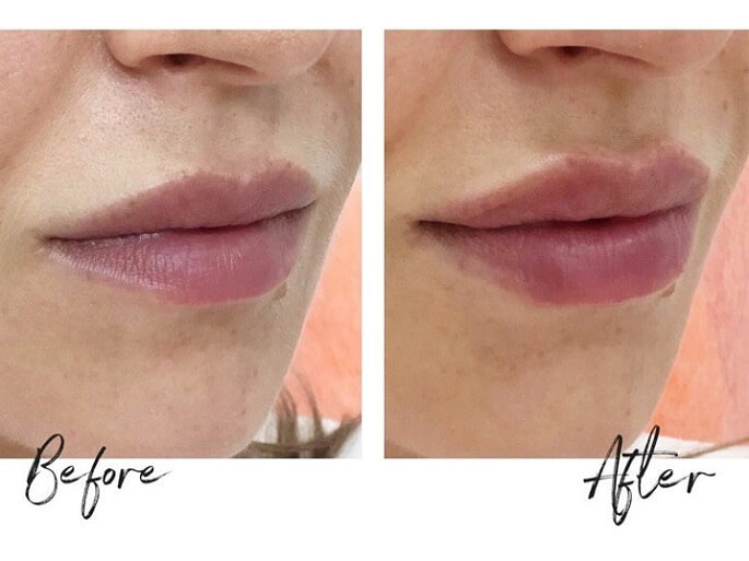 Збільшення губ гіалуроновою кислотою: фото до і після