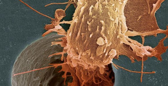 Три способи побачити рак легенів по руках
