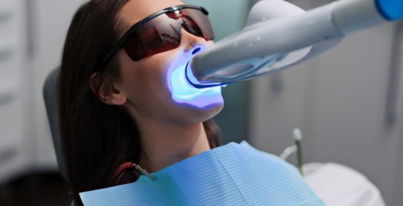 Серйозні ризики: стоматолог застеріг від самостійного відбілювання зубів