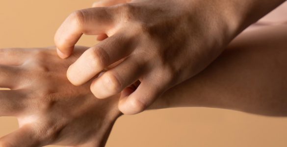 Лікарі пояснили, що допоможе позбутися неприємного стану шкіри