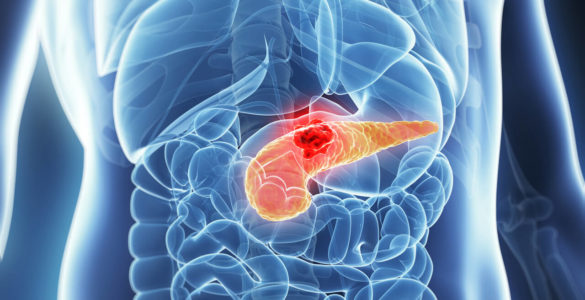 Ознаки раку підшлункової залози можуть виникнути за два роки до виявлення