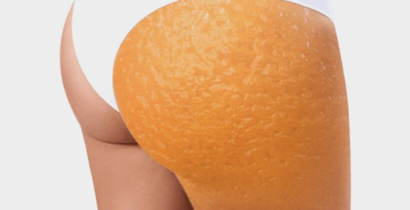 Міфи про целюліт: чому "апельсинову кірку" не треба лікувати