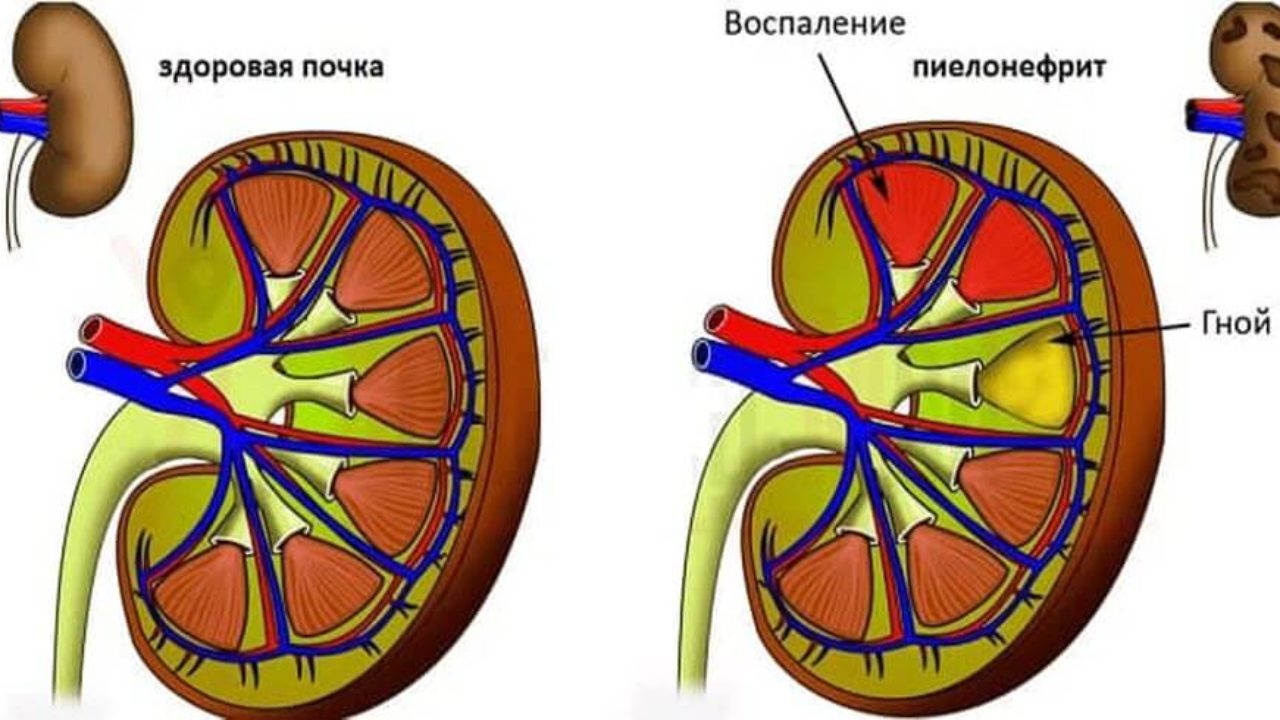 Как побороть пиелонефрит