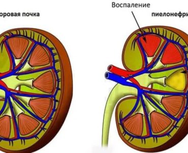 Пієлонефрит