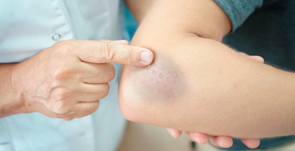 Захворювання печінки: два симптоми на шкірі вкажуть на небезпечний стан