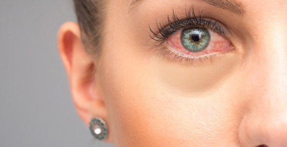 5 основних причин почервоніння очей