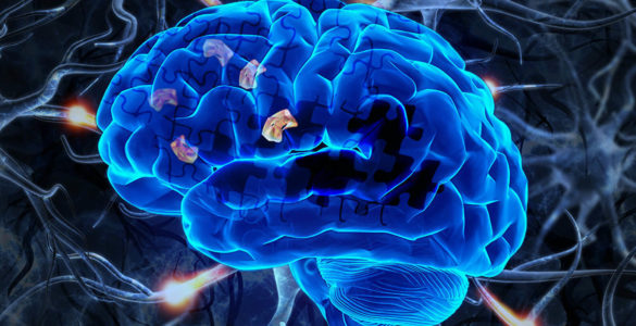 Пересадка стовбурових клітин відновила мозок при хворобі Альцгеймера