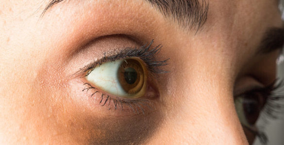 Якість зору: чому білки очей змінюють колір і коли це небезпечно